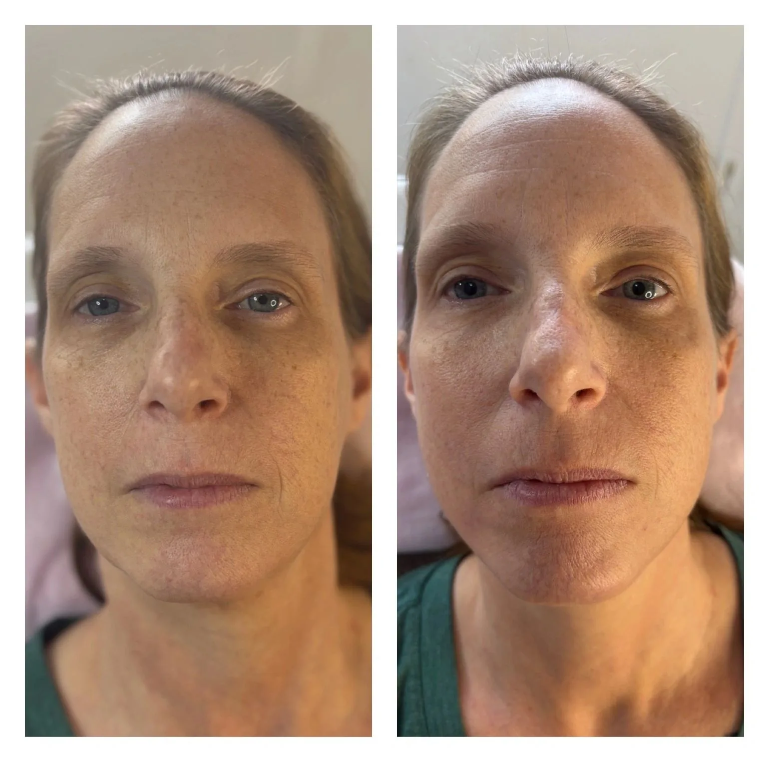 Skin Boosters — before & after