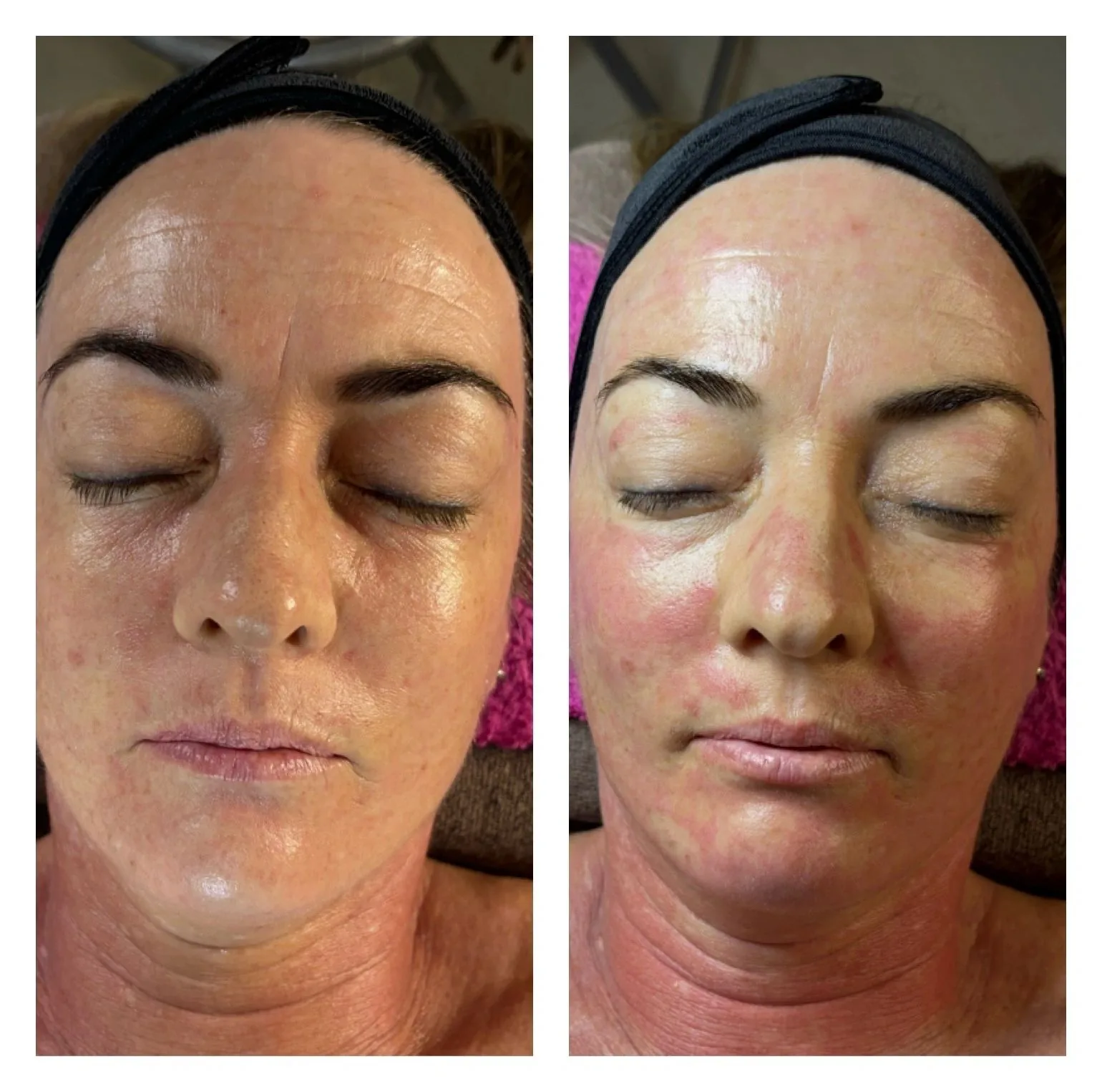 Dermapen Micro-Needling — before & after